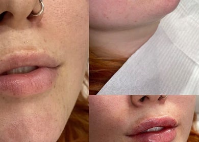 Close-up of aesthetic lip treatment at Ebbsfleet Aesthetics, Northfleet, England, GB showing smooth, enhanced lips.