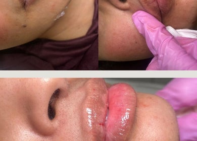 Lip enhancement procedure at Ebbsfleet Aesthetics, Northfleet, England, GB showing glossy results.