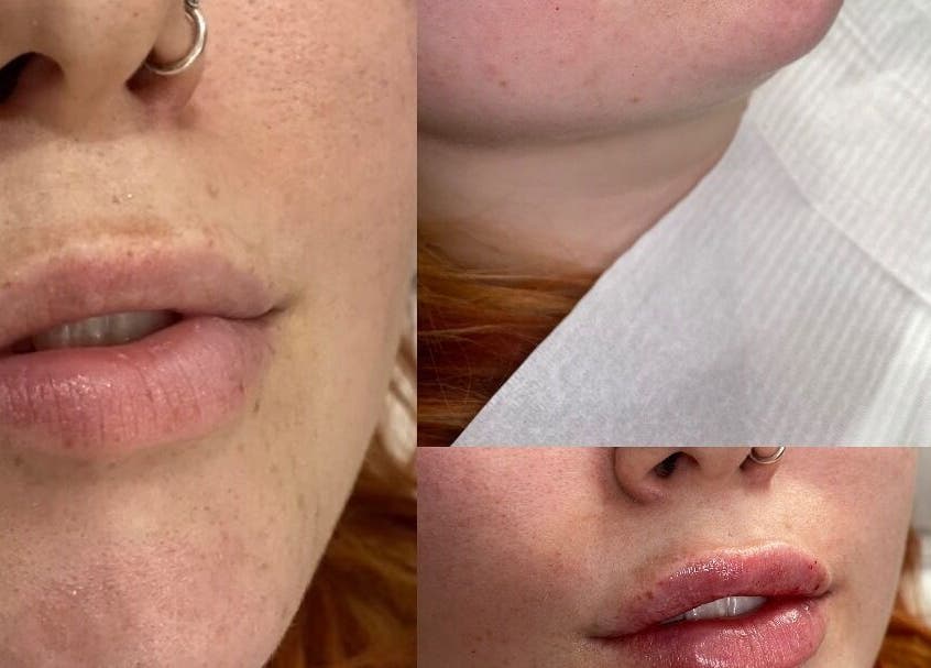 Lips before and after enhancement at Ebbsfleet Aesthetics, Northfleet, England, GB.
