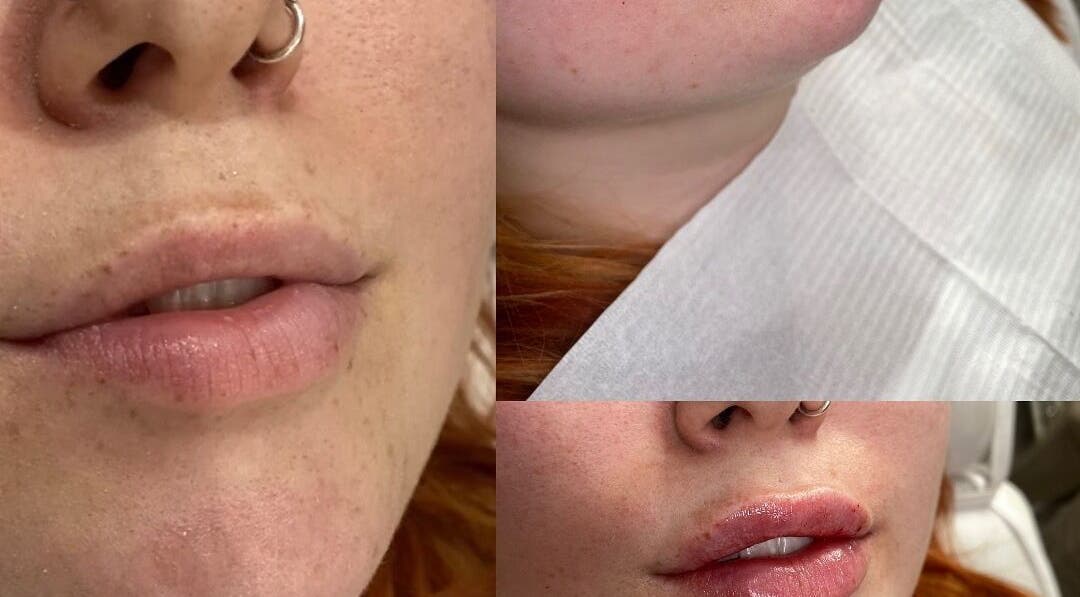Lips before and after enhancement at Ebbsfleet Aesthetics, Northfleet, England, GB.