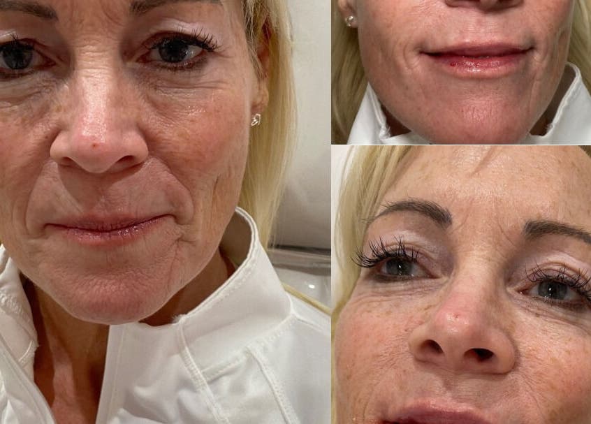 Before and after facial transformation at Ebbsfleet Aesthetics, Northfleet, England, GB. Remarkable skin difference.