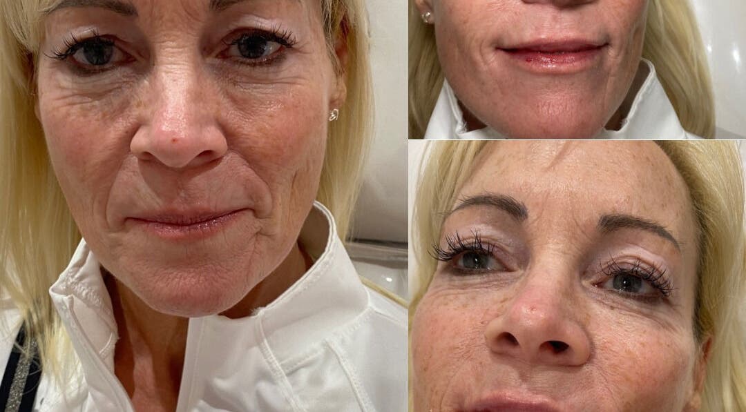 Before and after facial transformation at Ebbsfleet Aesthetics, Northfleet, England, GB. Remarkable skin difference.