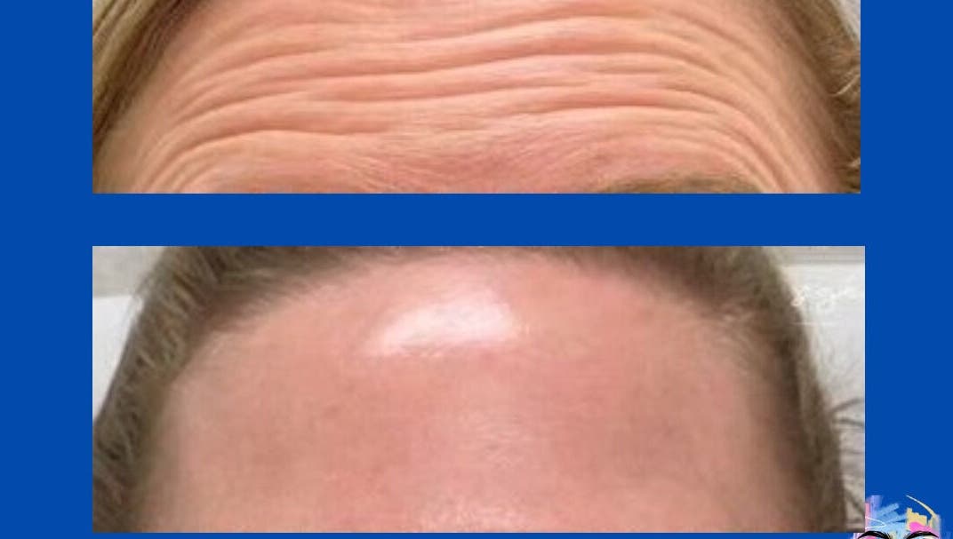 Before and after wrinkle treatment at De-Vaux Aesthetics, Tattingstone, England, GB.