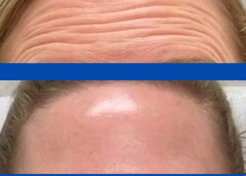 Before and after wrinkle treatment at De-Vaux Aesthetics, Tattingstone, England, GB.