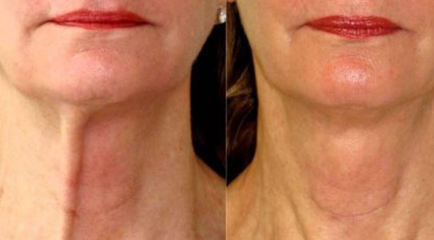 Before and after neck treatment at De-Vaux Aesthetics, Tattingstone, England. Visible skin transformation showcased.