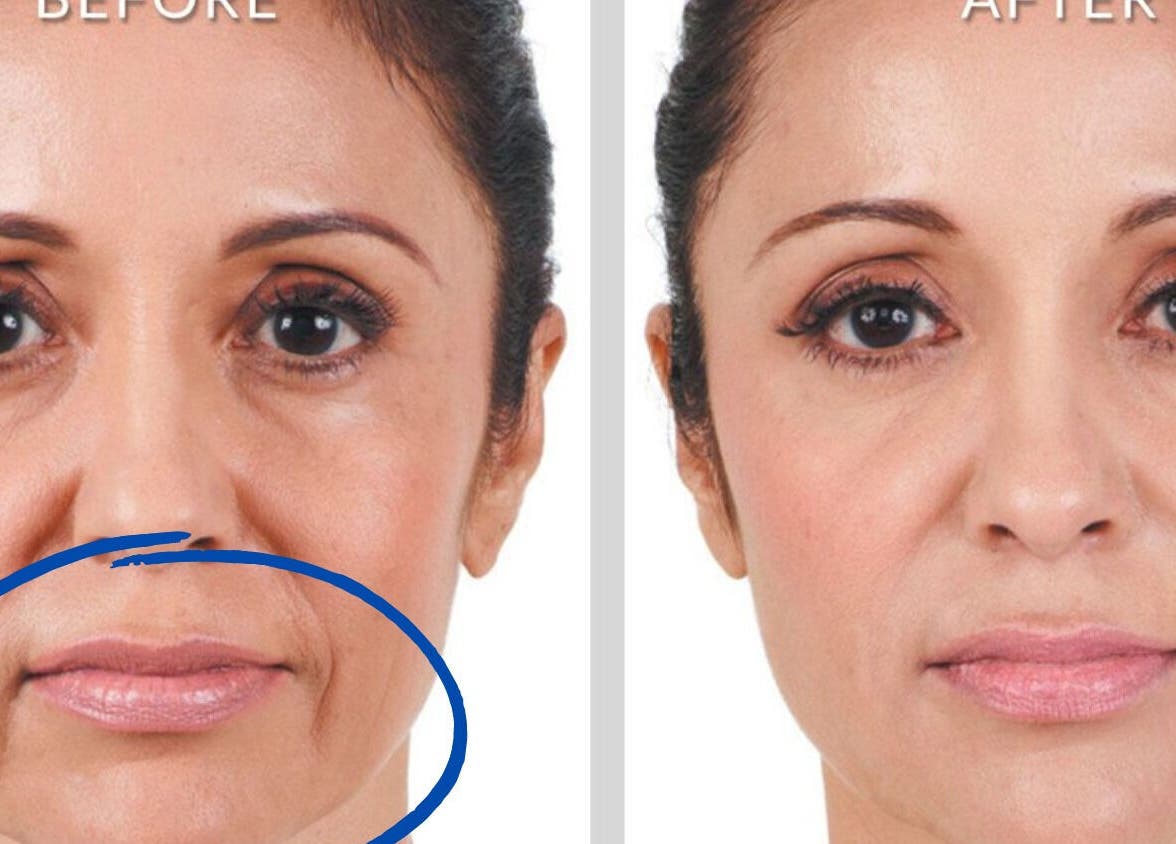 Before and after facial treatment at De-Vaux Aesthetics, Tattingstone, England, GB, showcasing skin rejuvenation.