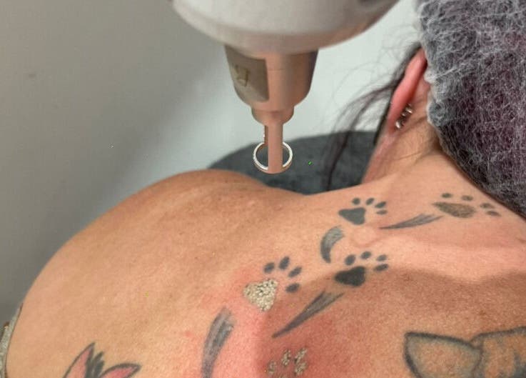 Laser tattoo removal in progress at De-Vaux Aesthetics, Tattingstone, England, GB.