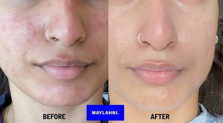 Maylahni Skin and Aesthetics Clinic: CLINIC APPOINTMENTS. Acne & Hyperpigmentation specialists slika 3