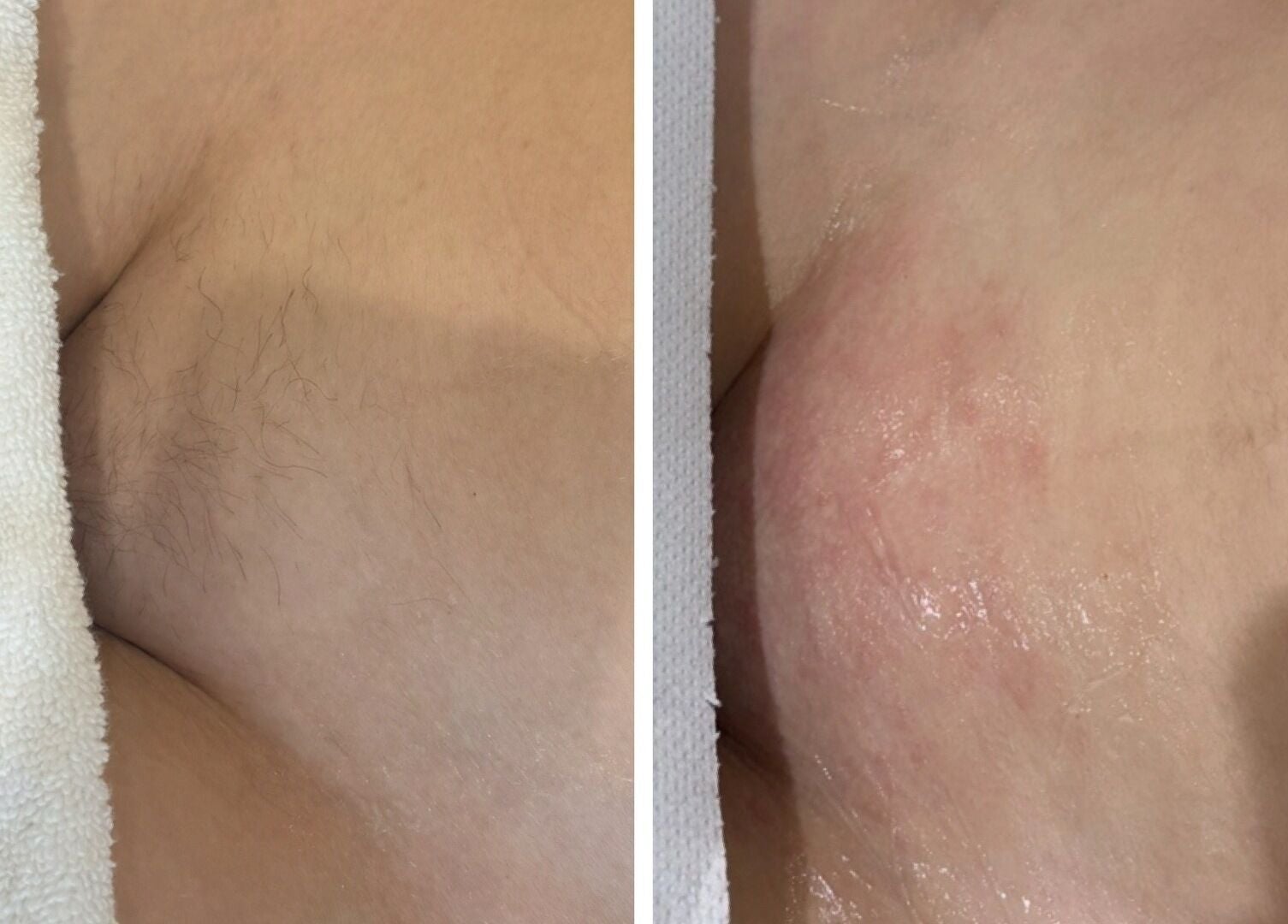 Before and after hair removal at Laser Lounge, Ramsbottom, England, GB.