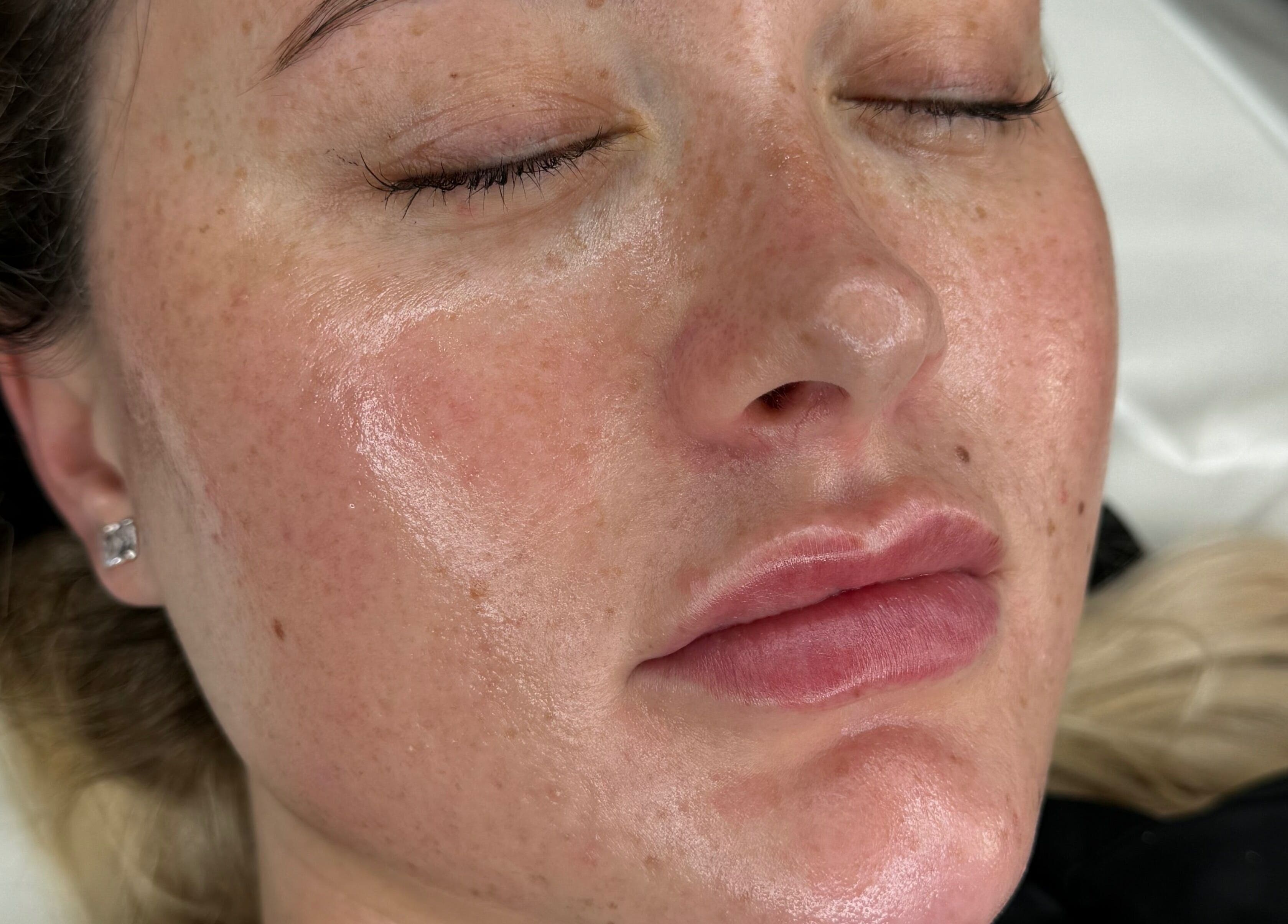Close-up of luminous skin post-treatment at Phace Institute, Belfast, Northern Ireland, GB.