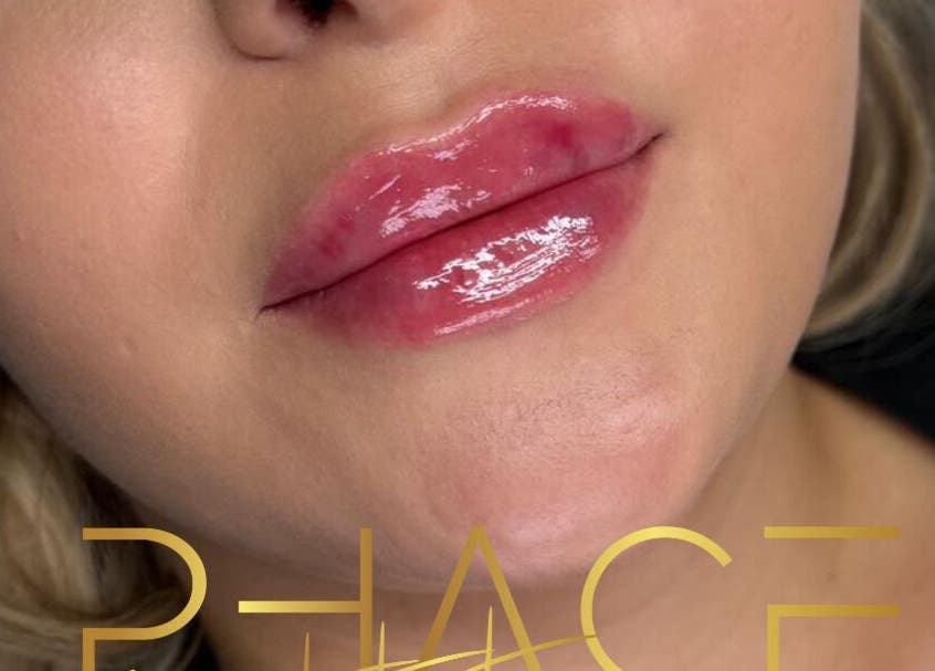 Glossy lips treatment at Phace Institute, Belfast, Northern Ireland, GB, showcasing sleek and shiny finish.