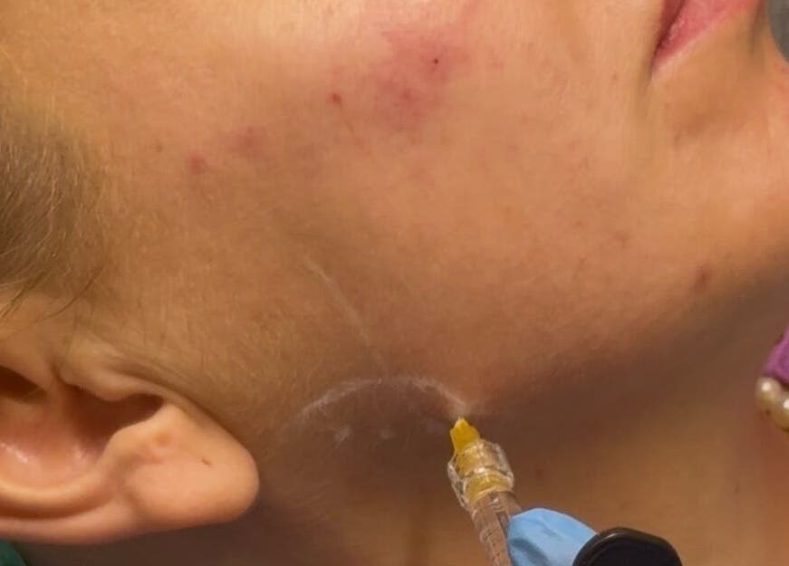 Facial treatment at Phace Institute, Belfast, Northern Ireland, GB showing skin rejuvenation process.