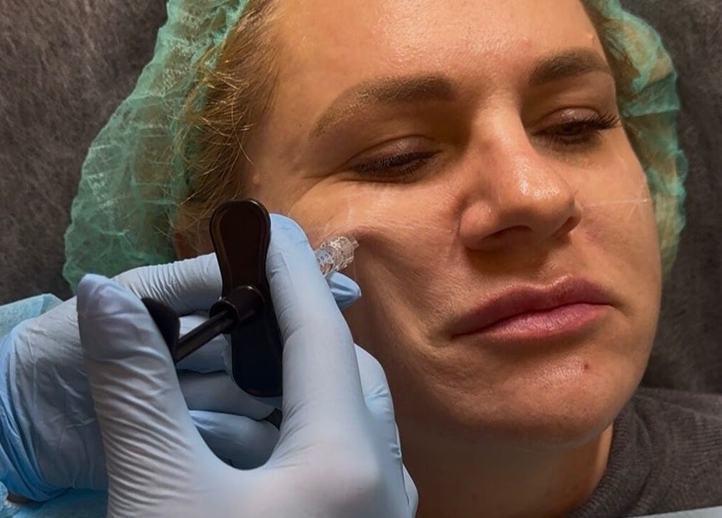 Facial rejuvenation treatment at Phace Institute, Belfast, Northern Ireland, GB.