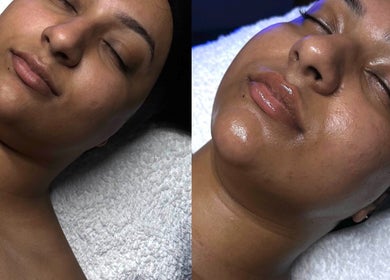 Facial treatment at Signature Skin, Taverham, England, GB showing smooth glowing skin transformation.