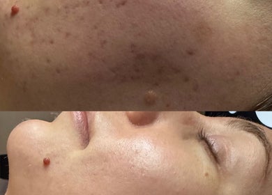 Before and after skin treatment at Signature Skin, Taverham, England, GB showcasing a smoother complexion.
