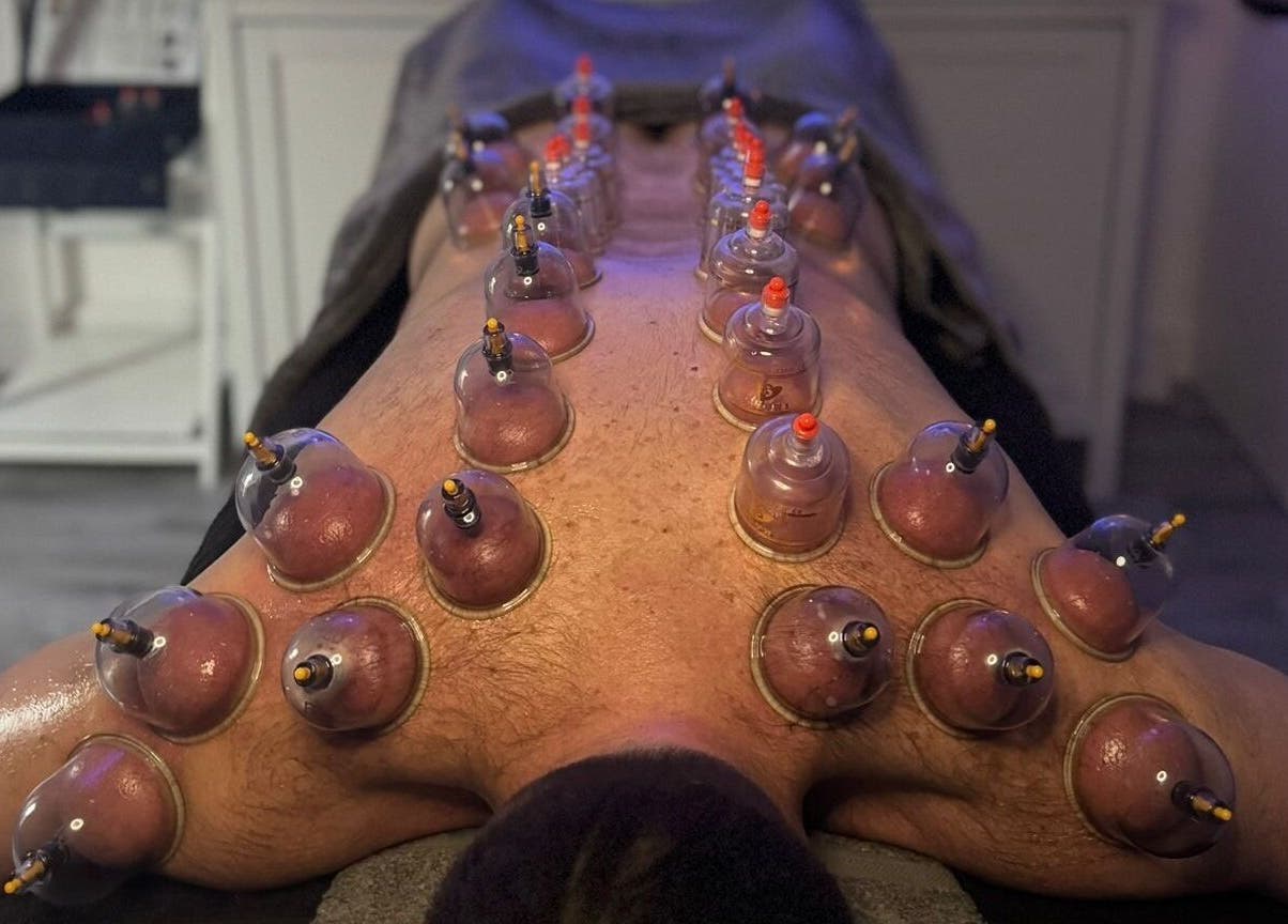 Cupping therapy session at VALER Massage Therapist and Male Waxing in Ruislip, England, GB.