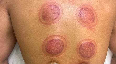 The hijama nurse image 3