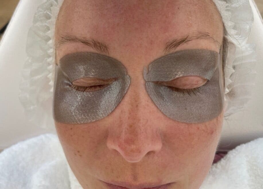 Rejuv by V eye mask treatment in Newcastle, England, GB with hydrating silver patches on closed eyes.