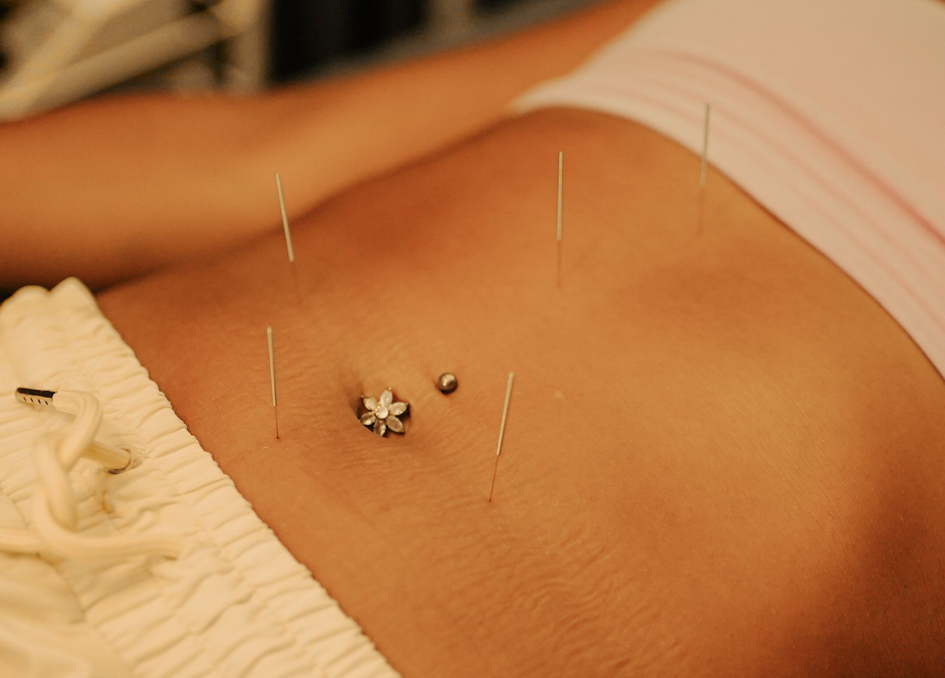 Acupuncture session at Acupuncture Bali, Nusa Dua, enhancing wellness, Bali, Bali, ID.