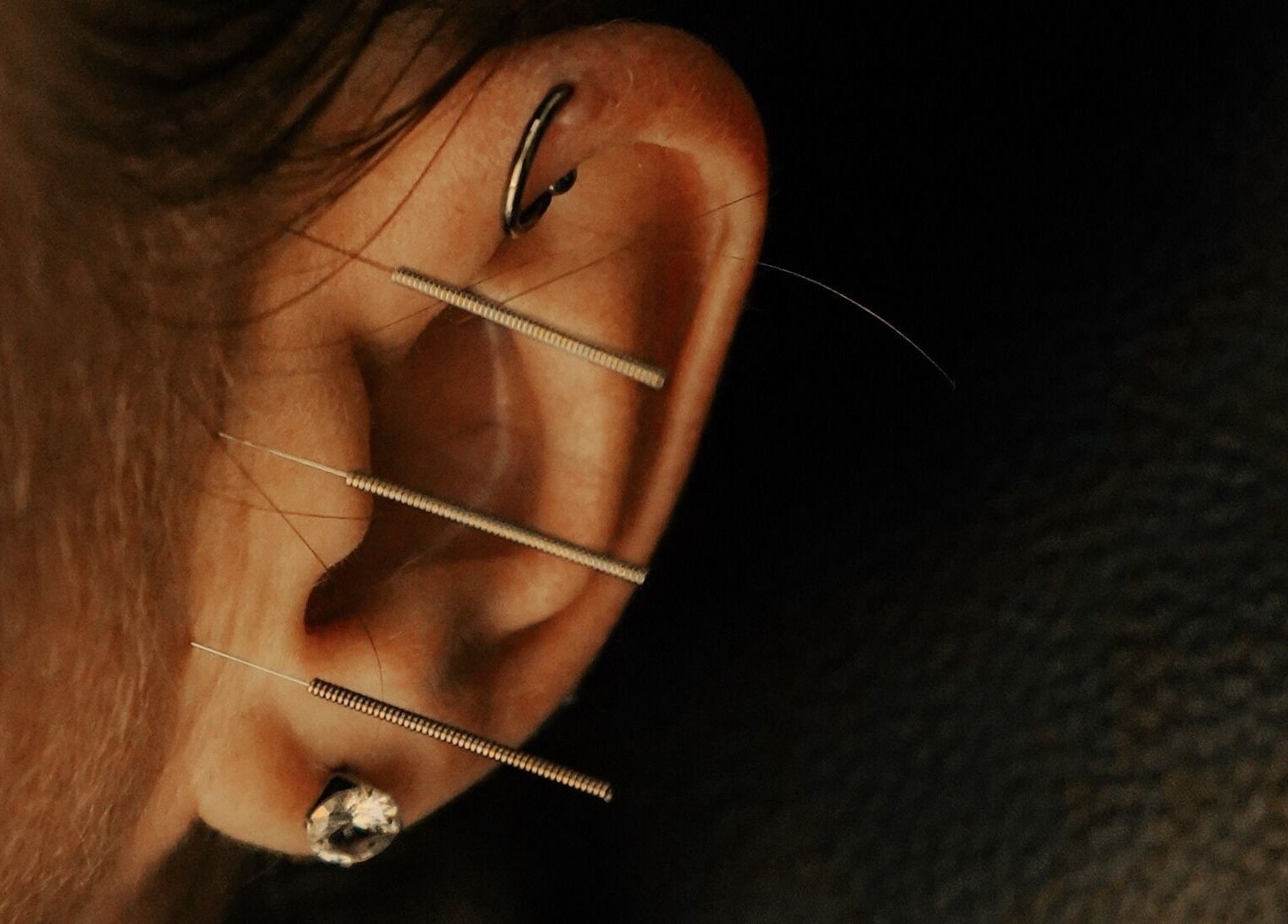 Close-up of ear acupuncture at Acupuncture Bali, Nusa Dua, Bali, Bali, ID with delicate needles.