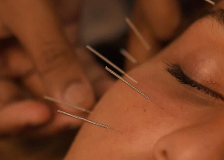 Relaxing facial acupuncture at Acupuncture Bali, Nusa Dua, Bali, Bali, ID enhances wellness and balance.