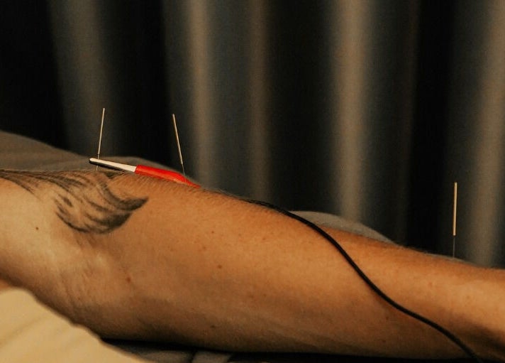Acupuncture session at Acupuncture Bali, Nusa Dua in Bali, Bali, ID with needles on arm.
