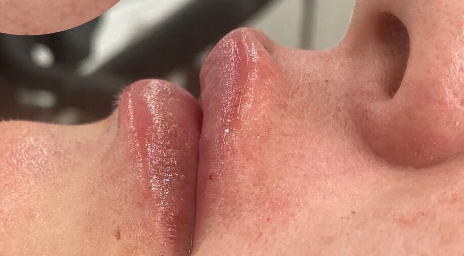 Close-up of glossy, hydrated lips after treatment at hd aesthetics Bearsted, Bearsted, England, GB.
