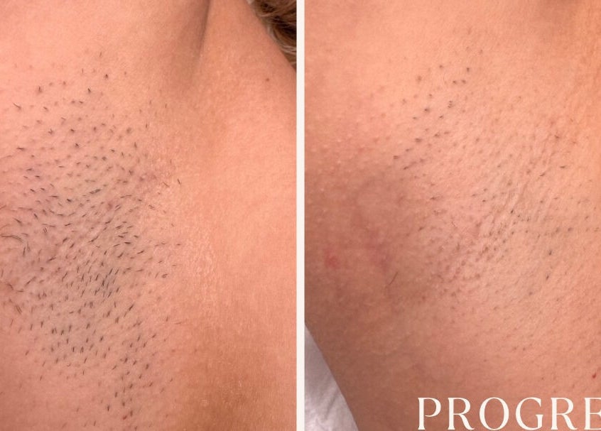 Before and after laser hair removal at Ola’s Studio26, Cheltenham, England, GB.