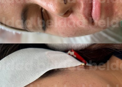 Tratamiento facial en Beldad.mx para piel revitalizada en San Francisco Coacalco, Estado De México, MX.
