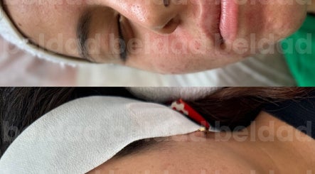 Tratamiento facial en Beldad.mx para piel revitalizada en San Francisco Coacalco, Estado De México, MX.