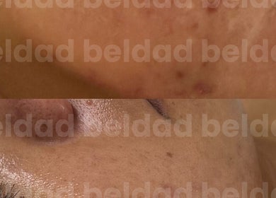 Transformación facial en Beldad.mx, San Francisco Coacalco, Estado De México, MX, mostrando mejora de la piel.