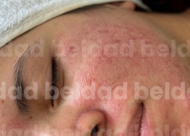 Tratamiento facial en Beldad.mx, San Francisco Coacalco, Estado De México, MX para rejuvenecer la piel.