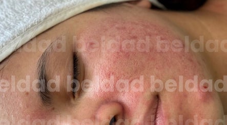 Tratamiento facial en Beldad.mx, San Francisco Coacalco, Estado De México, MX para rejuvenecer la piel.