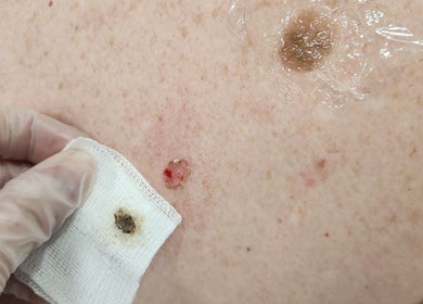 Treatment at Youthful Glow Skin and Body Clinic in Mountain Creek, Queensland, AU for a skin condition.