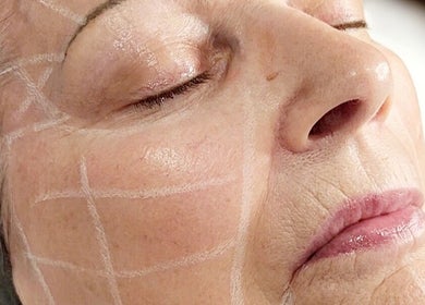 Facial treatment at Youthful Glow Skin and Body Clinic, Mountain Creek, Queensland, AU showing precise skincare.