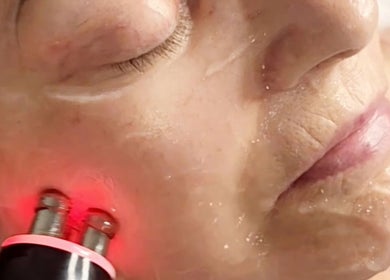 Facial treatment at Youthful Glow Skin & Body Clinic, Mountain Creek, Queensland, AU.