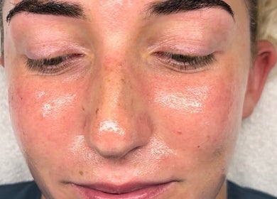 Close-up of a radiant face post-treatment at skinbyparvati_ in Over Hulton, England, GB.