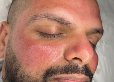 Close-up of rejuvenated skin after treatment at skinbyparvati_, Over Hulton, England, GB.