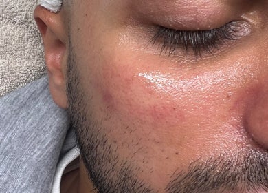 Close-up of glowing skin after treatment at skinbyparvati_ in Over Hulton, England, GB.