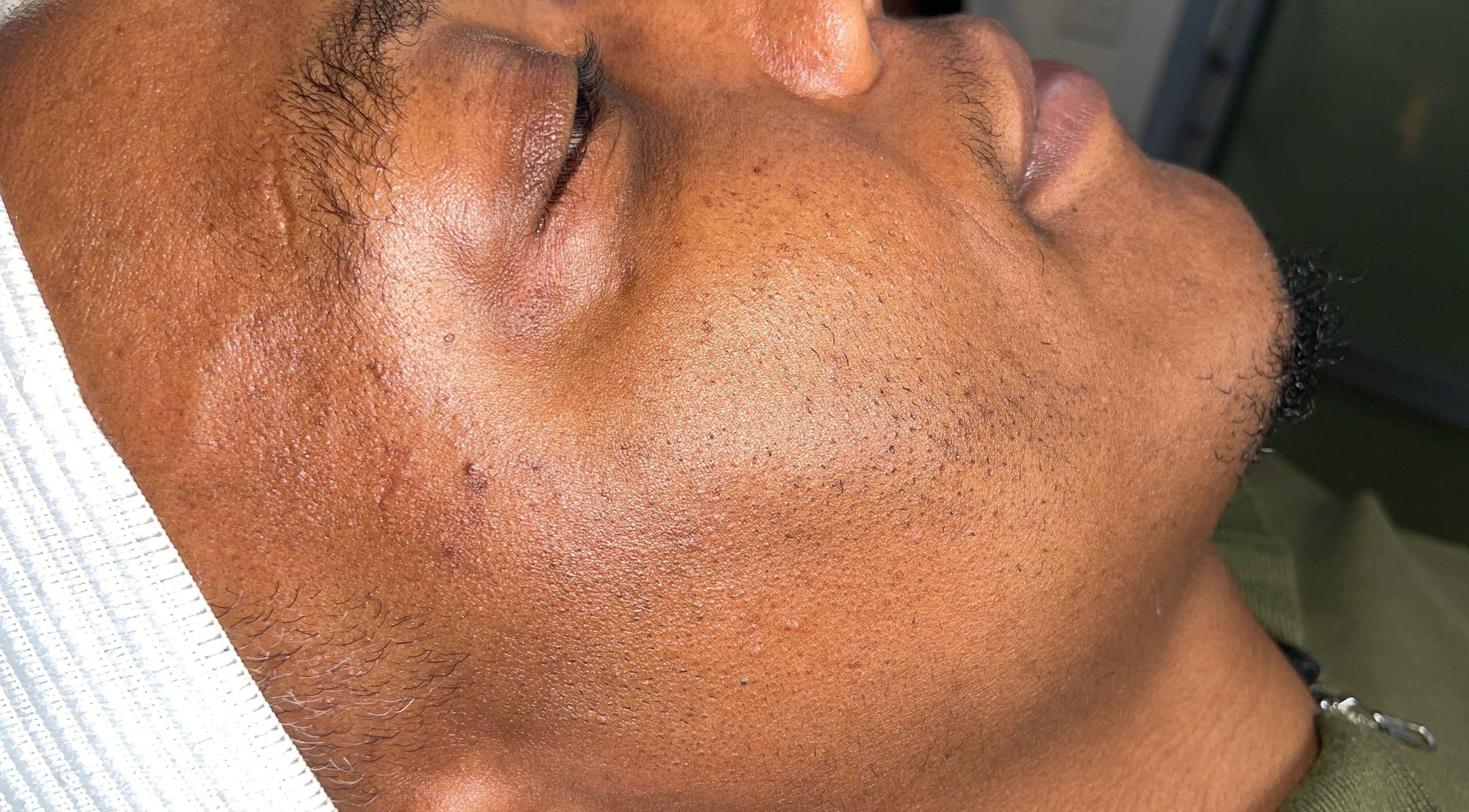 Close-up of a relaxed face at Chateaú Aesthetics in Decatur, Georgia, US after skincare treatment.