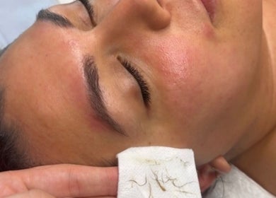 Facial treatment at Skinngleam Esthetics in Boca Raton, Florida, US, showcasing smooth, refreshed skin.