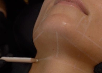 Facial contouring procedure at Regen Skin, Melbourne, Victoria, AU enhancing natural beauty.