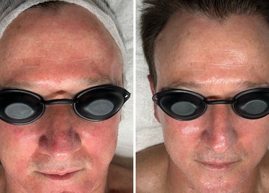 Before and after facial at Glow Your Skin by Shona, Chapel Hill, Queensland, AU. Visible skin improvement.