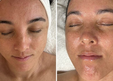 Before and after facial treatment at Glow Your Skin by Shona in Chapel Hill, Queensland, AU.