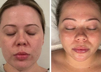 Before and after facial results at Glow Your Skin by Shona, Chapel Hill, Queensland, AU.