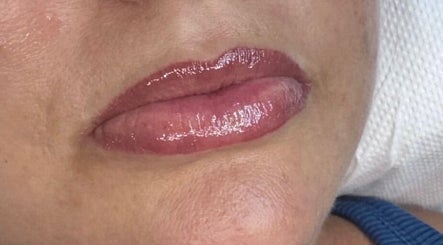 Close-up of glossy lips at Mad Aesthetics, Southampton, England, GB, showcasing a perfect lip enhancement.