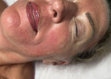 Facial treatment at Mad Aesthetics, Southampton, England highlighting post-care glow.
