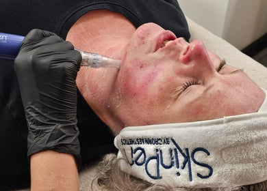 Microneedling treatment at DermaDivine Skin Rejuvenation in Tamworth, England, GB for skin revitalization.