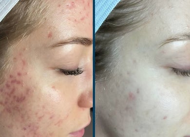 Before and after acne treatment at DermaDivine Skin Rejuvenation, Tamworth, England, GB, showcasing clear skin.