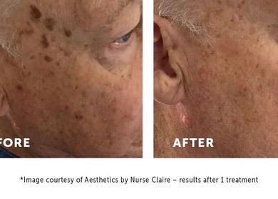 Before and after skincare results at Just Skin Uk, Cardiff, Wales, GB, showcasing improved skin clarity.